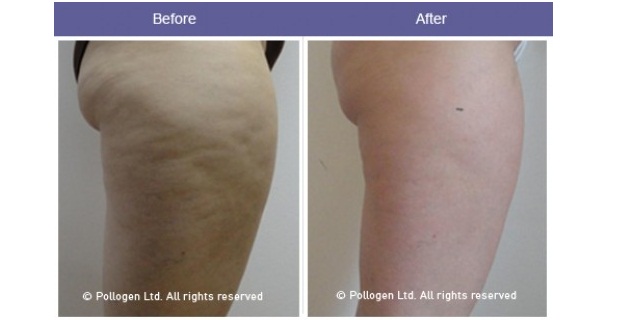 5 Cellulite Removal Treatments–Just in Time for Summer - Spafinder