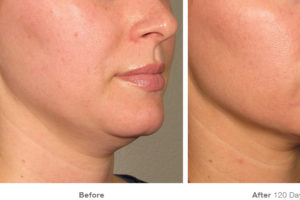 ultrasound results under chin