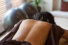 acupuncture-back
