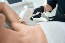 laser-hair-removal