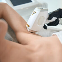 laser-hair-removal