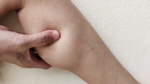 Lipedema-lympathic-drainage-massage